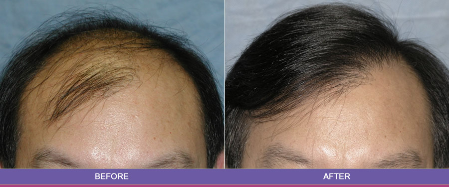 regrow of hair loss